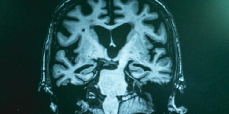 Beyond Amyloid Plaques: Scientists Reveal Broader Chemical Disruptions in Alzheimer’s