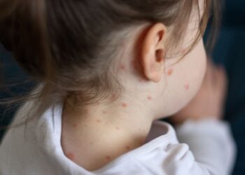 What are the symptoms of measles – and what should you do if you think your child is infected? | UK News