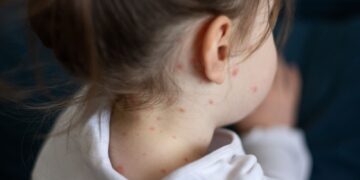 What are the symptoms of measles – and what should you do if you think your child is infected? | UK News