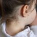 What are the symptoms of measles – and what should you do if you think your child is infected? | UK News