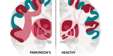 This complex brain network may explain many of Parkinson’s stranger symptoms : NPR
