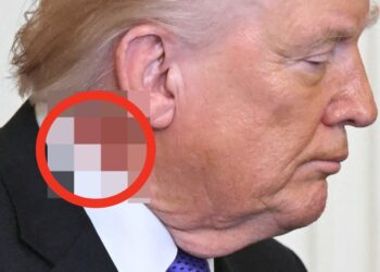 What’s Up With Trump’s Angry Neck Rash? We Asked The Experts.
