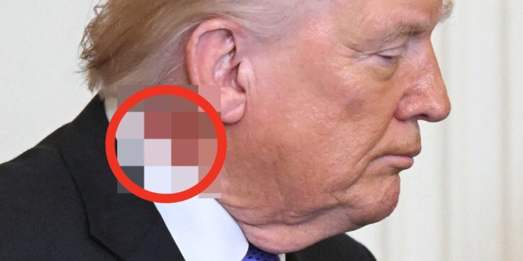 What’s Up With Trump’s Angry Neck Rash? We Asked The Experts.