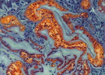 Breakthrough Discovery Could Make Pancreatic Cancer Respond to Chemo Again