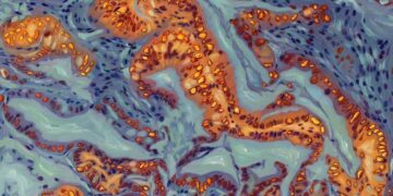 Breakthrough Discovery Could Make Pancreatic Cancer Respond to Chemo Again