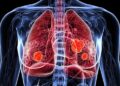 A Bad Case of COVID or Flu May Raise Lung Cancer Risk Years Later