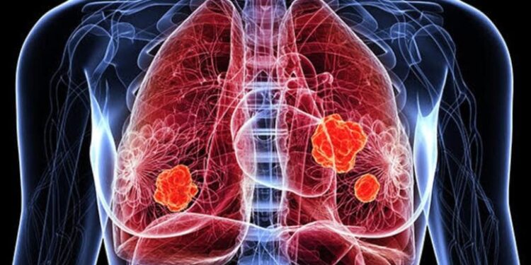 A Bad Case of COVID or Flu May Raise Lung Cancer Risk Years Later